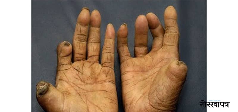 कुष्ठरोग निर्मूलीकरण घोषणा मात्रै