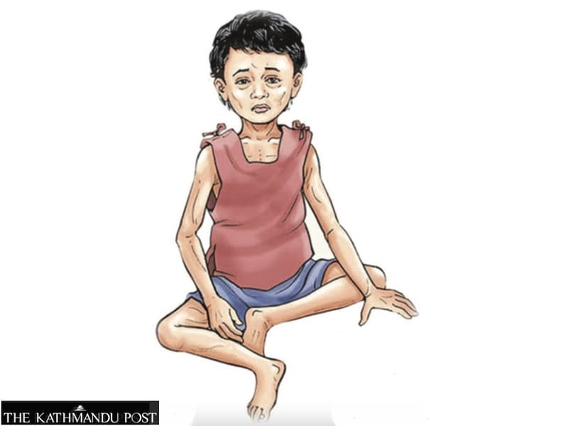 Malnutrition ravages Sudurpaschim as politics ignores a silent crisis