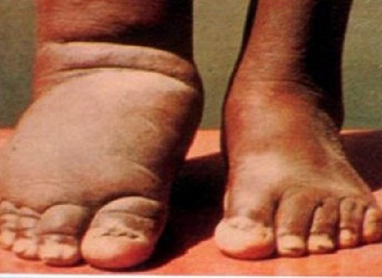 Over 430,000 people in Sarlahi to receive medicine against elephantiasis