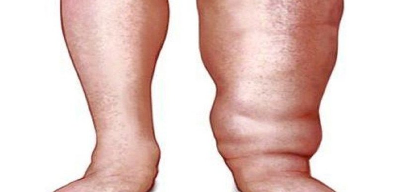 झापामा करिब ३ लाखलाई हात्तीपाइले रोगविरुद्धको औषधि खुवाइँदै