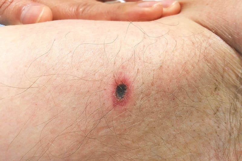 Scrub typhus has topped dengue in Nepal this year