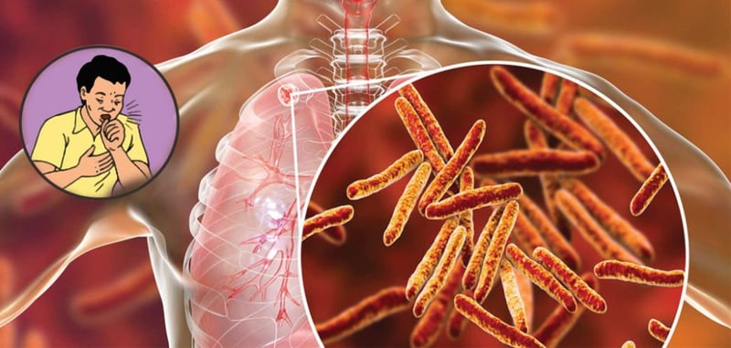 42 percent TB patients still out of treatment in Nepal