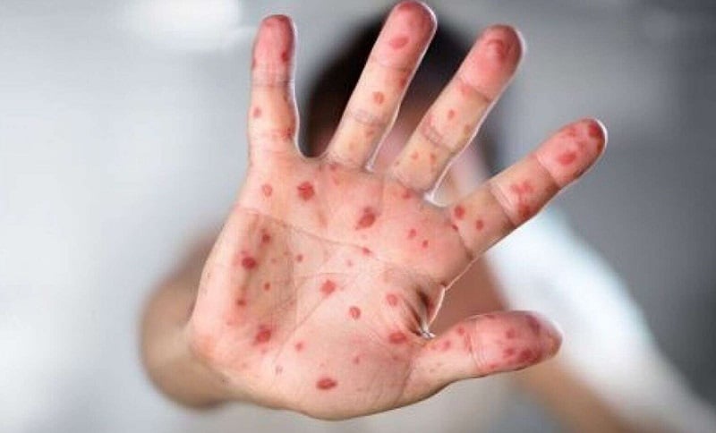 ढोरपाटनमा दादुरा विरुद्धको खोप अभियान सञ्चालन गरिने