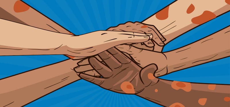 पर्वतमा कुष्ठरोगीको सङ्ख्या घट्दै, चारजना उपचाररत