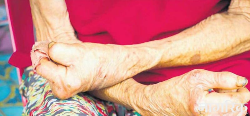 कुष्ठरोगीको सङ्ख्या शून्यमा झार्न सचेतना आवश्यक