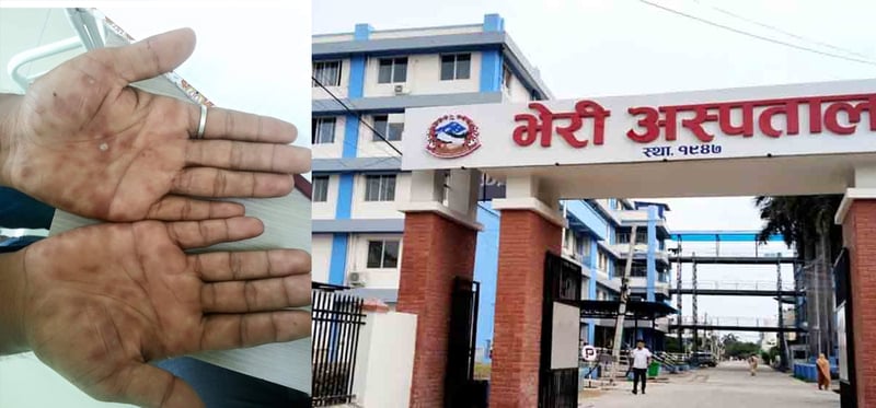 भेरी अस्पतालमा भिरिंगी रोगसम्बन्धी अनुसन्धान सुरु