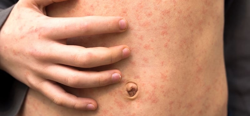 ढोरपाटनमा समुदायस्तरमा फैलियो दादुरा : भोलिदेखि खोप लगाइने