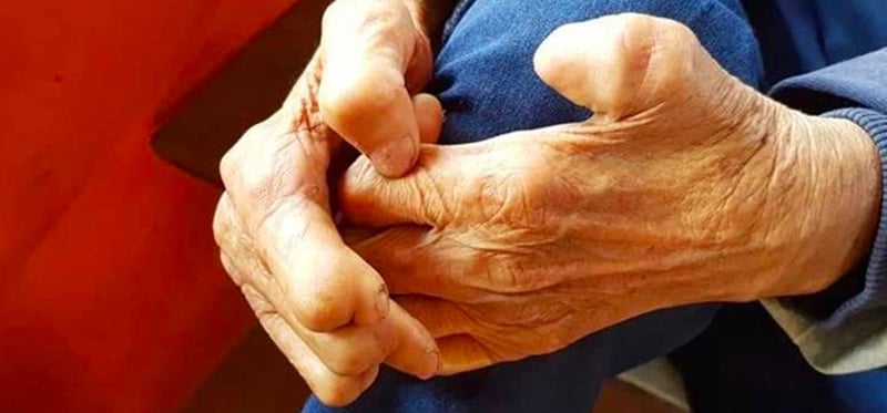 कुष्ठरोग नियन्त्रण गर्न बढ्दो चुनौती, मधेसका ४५ पालिका कुष्ठरोगमुक्त