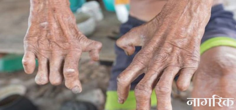 कुष्ठरोग प्रभावितमाथि अझै विभेद : कानुन पुनरावलोकन गर्न सुझाव