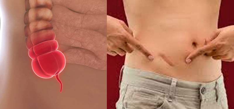 एपेन्डिक्स के हो? किन दुख्छ? लक्षण र उपचार के के ?