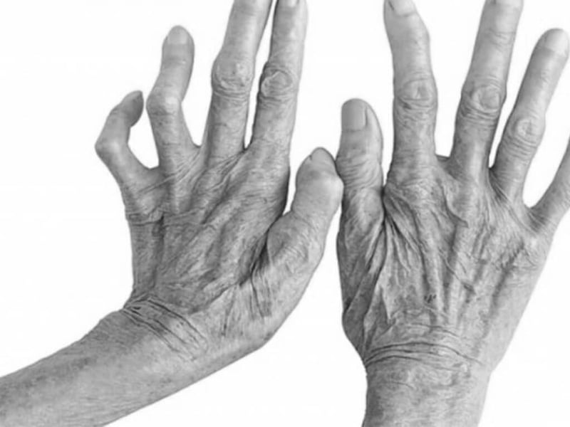 नवलपरासीपूर्वमा ३० कुष्ठरोगीको उपचार हुँदै