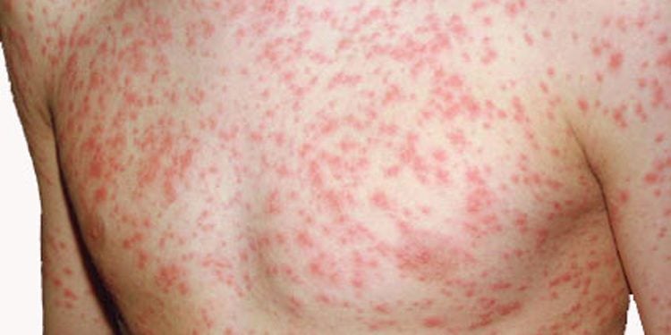 बाग्लुङमा दादुराका ६७ बिरामी उपचारपछि घर फर्के, २० जनाको ‘आइसोलेसनमा’ उपचार जारी