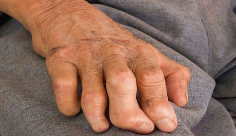 झापामा ५५ जना नयाँ कुष्ठरोगी फेला, नयाँ रोगीको सङ्ख्या बर्सेनि बढ्दै