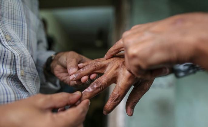 छ महिनाभित्र बाँकेमा ८६ जनामा कुष्ठरोग पुष्टि