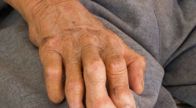 बाँकेका दुर्गम स्थानमा कुष्ठरोगीको पहिचान खुल्दै