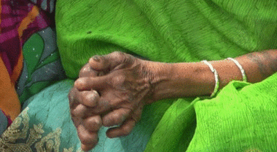 झापामा ५५ जना नयाँ कुष्ठरोगी फेला