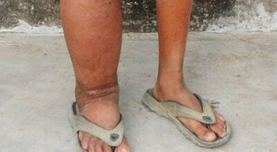 हात्तीपाइलेविरुद्धको दशदिने औषधि सेवन अभियान