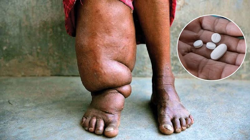 सर्लाहीका यी १२ पालिकामा फेरि फैलियो हात्तीपाइले, ४ लाखभन्दा धेरैलाई औषधि खुवाउने तयारी