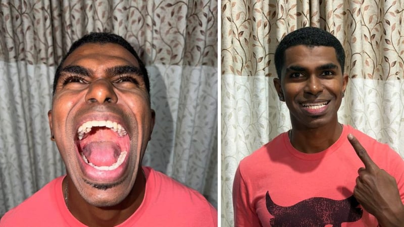 मलेसियाका एक युवाको ४२ वटा दाँत, गिनिज बुकमा लेखाए नाम