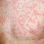 मलंगवामा दादुराको प्रकोप, ८ हजार बालबालिकालाई खोप दिने अभियान सुरु