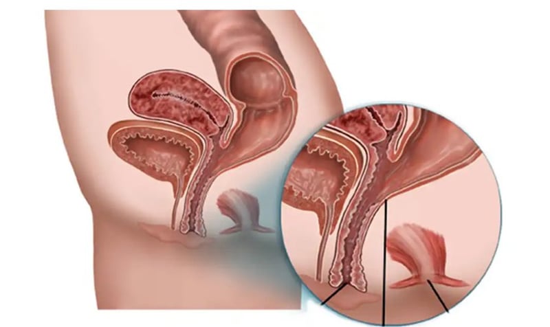 जीवनशैलीमा आएको परिवर्तनले पायल्स, फिस्टुला र फिसरका बिरामी बढ्दै