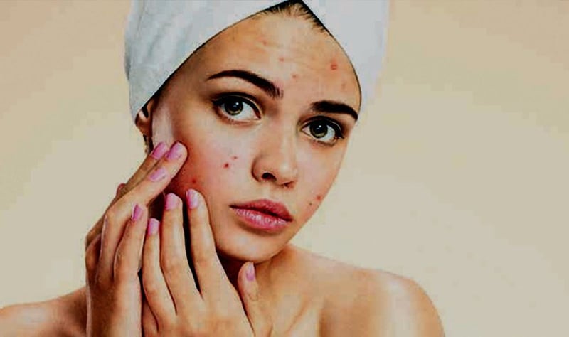 Dermatologists Warn Against Popping Pimples Due to Infection and Scarring Risks