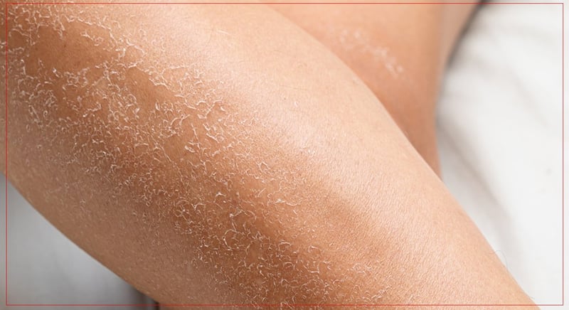 जाडोमा छालाको सुख्खापनबाट कसरी जोगिने ?