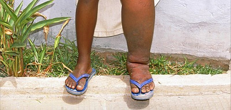 सर्लाहीमा चार लाखभन्दा बढीलाई हात्तीपाइलेविरुद्धको औषधि खुवाइने