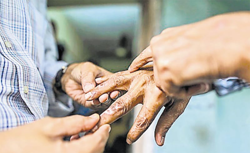 सुदूरपश्चिममा कुष्ठरोगको समस्या यथावत