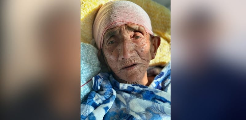 वीर अस्पतालमा १०३ वर्षीया वृद्धामा मस्तिष्कको शल्यक्रिया