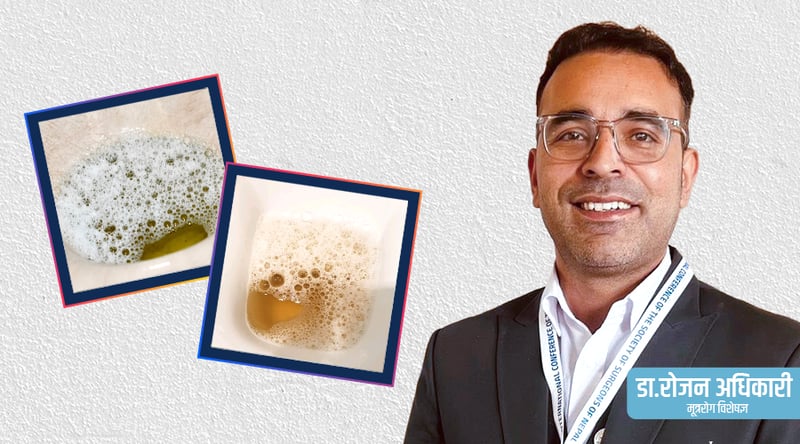 के पिसाबमा फिँज देखिनु कुनै रोगको संकेत हो ?