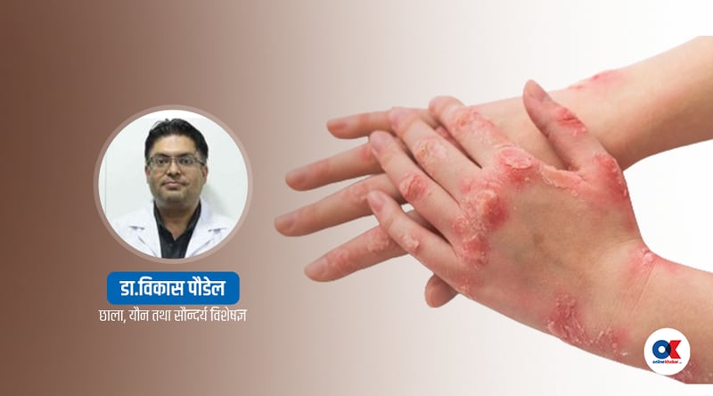 कुष्ठरोग : उन्मूलन घोषणा गरेको वर्षौं बित्यो, अझै किन छ नेपालमा ?