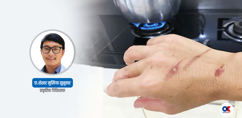 हात पोल्यो, तुरुन्त के गर्ने ? जानी राखौं ६ घरेलु उपाय