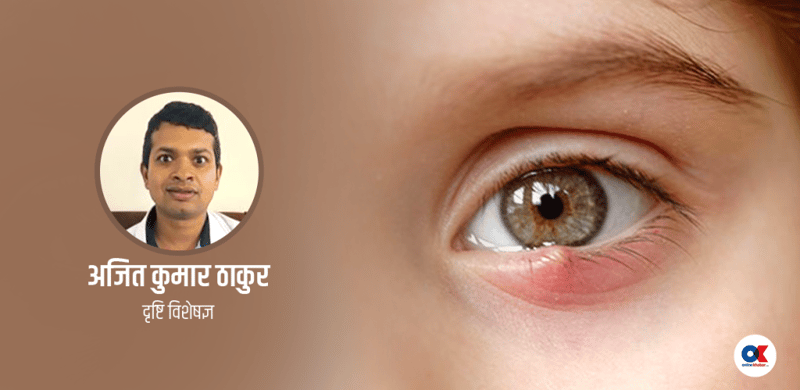 डेढो आँखा हुनु कुनै रोगको संकेत पनि हुन सक्छ, कसरी हुन्छ उपचार ?