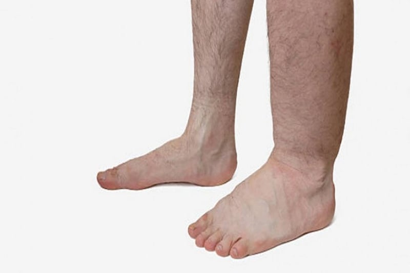 10-day mass drug administration campaign against elephantiasis begins today