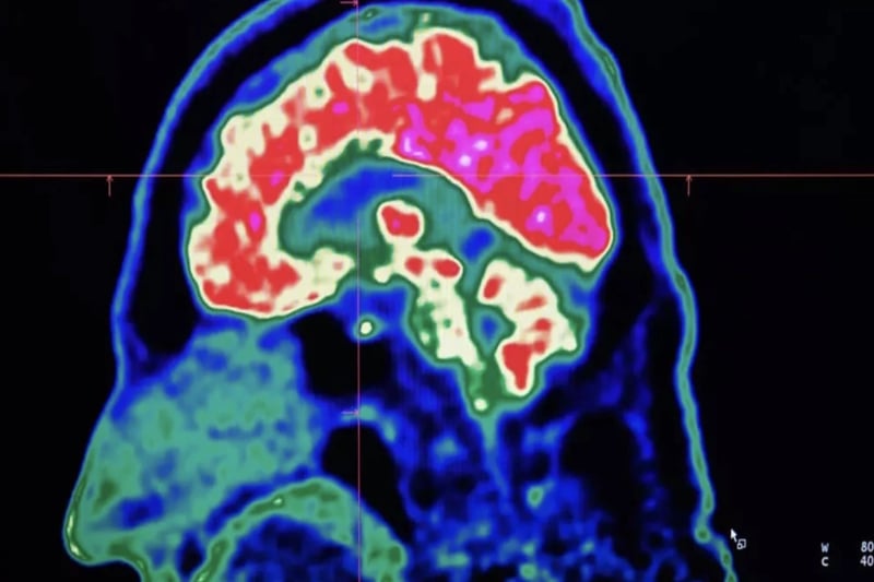Final report casts doubt on existence of Canada mystery brain illness