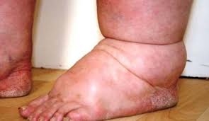 10-day mass drug administration campaign against elephantiasis begins today