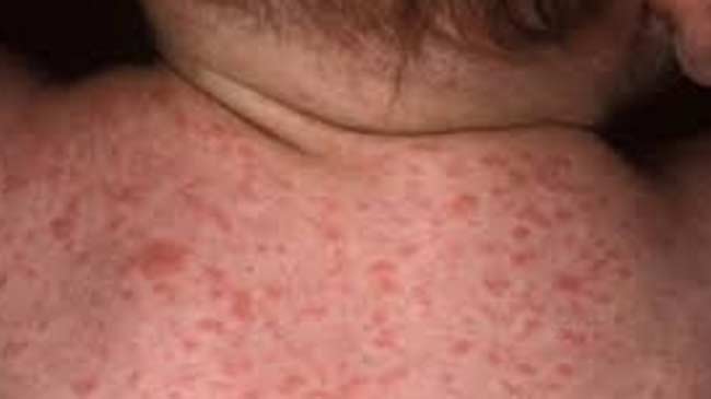 67 Measles Patients Recover in Baglung's Dhorpatan; 20 Remain Isolated