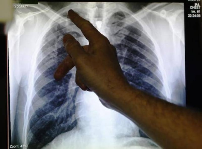 Financial constraints impeding Nepal's ambitious goal of ending tuberculosis