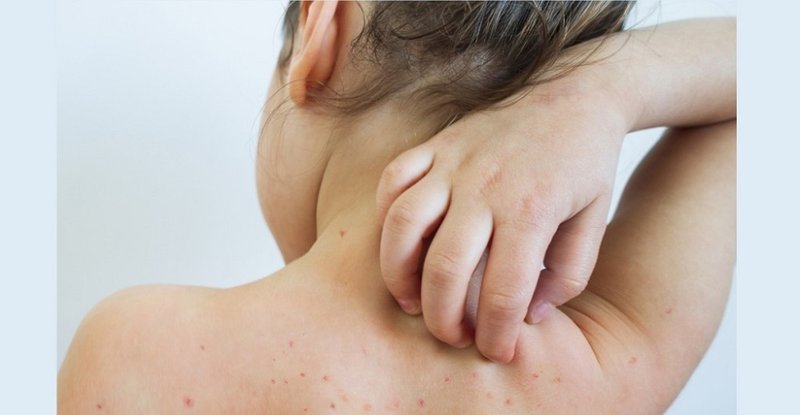 मलङ्गवामा फैलियो दादुरा सङ्क्रमण