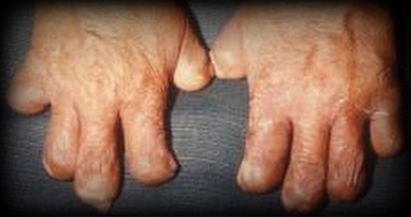 कण्ठरोग निवारणमा नेपालको ऐतिहासिक सफलता, गलगाँडको समस्या शून्य