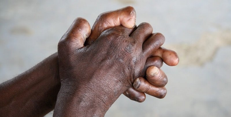 बालबालिकामा पनि कुष्ठरोगको सङ्क्रमण बढ्दो